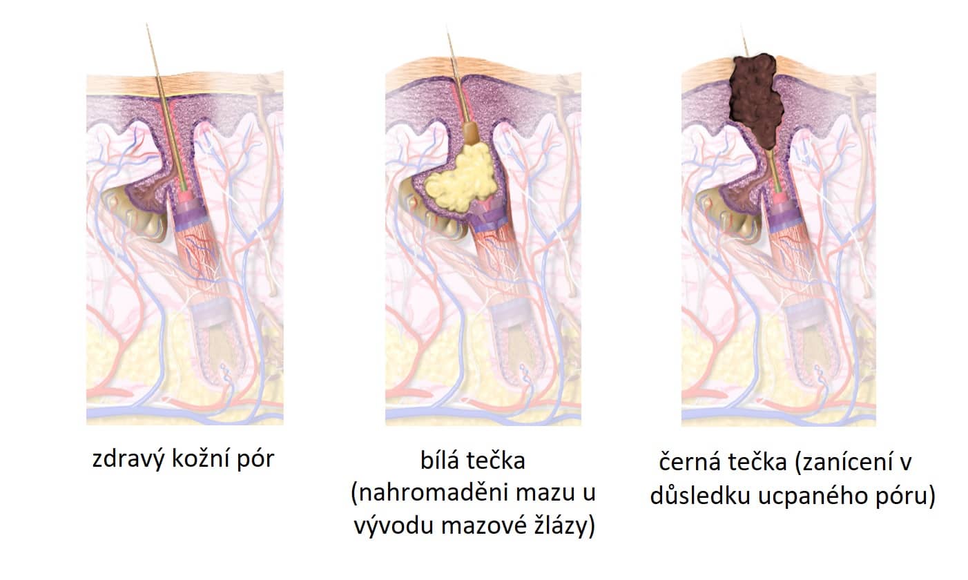 anatomie vzniku akné